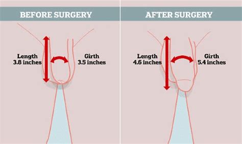 And i love a thick vein down the shaft, so you can see it's really hard. Androfill Australia · Fat Transfer Penis Enlargement ...