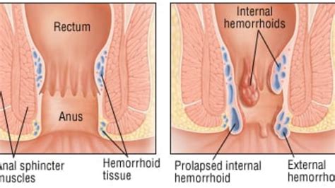 External hemorrhoids are visible from the outside. Hemorrhoids Treatment in Thailand - Almurshidi Medical ...