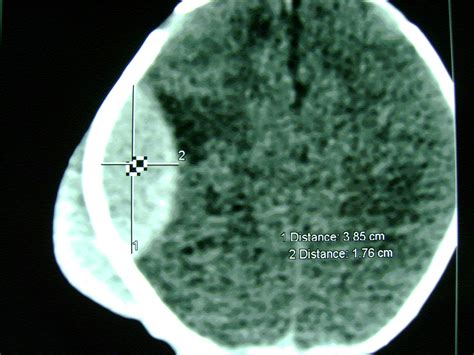 Right Parietal Swelling | Spot Diagnosis | Pediatric Oncall