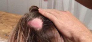 But doing so can cause serious damage, especially to thin strands. Scalp Archives | Skincarederm