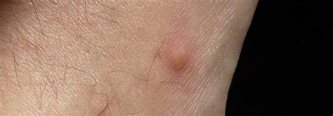 Jul 30, 2020 · itchy, scratchy, red, swollen, and unsightly, mosquitos bites can be unbearable. Spot an Allergic Reaction to Mosquito Bites | Natural ...