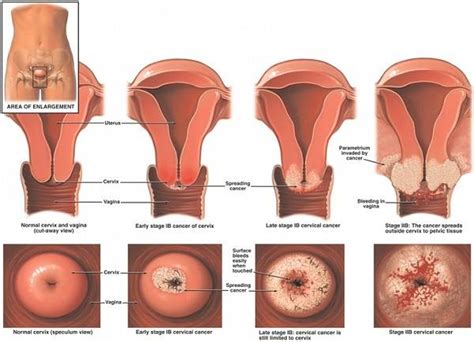 Kanker ini dapat hadir dengan pendarahan vagina. Sebelum Kahwin, Sila Check Tanda-Tanda Kanser Pangkal ...