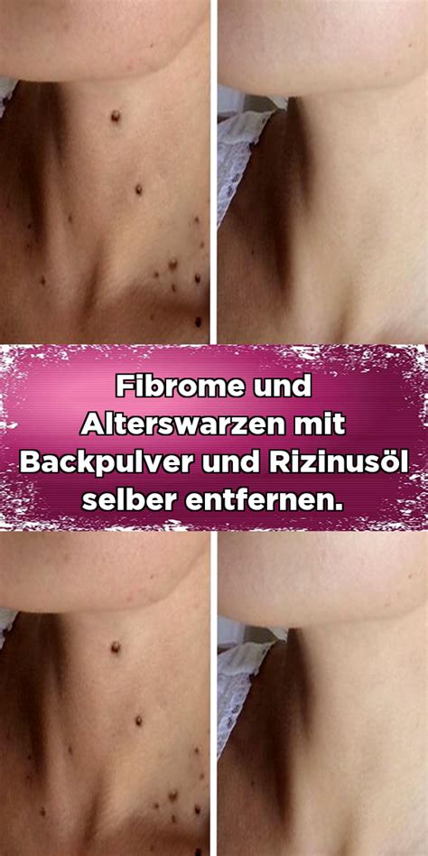 Ist ihre innere schamlippe größer als äußere, die schamlippe zu groß, schamlippe zu lang oder interessieren sie sich für dafür die klitoris verkleinern? Fibrome und Alterswarzen mit Backpulver und Rizinusöl ...