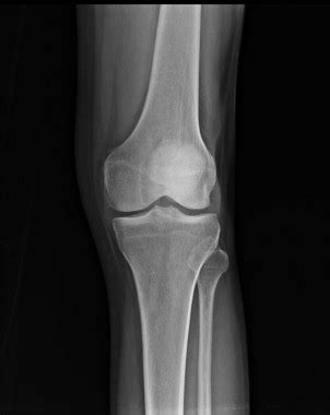 The origin of this tissue is controversial. Calcification de Pellegrini Stieda - PinkyBone