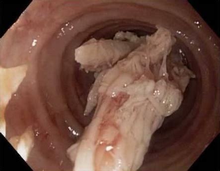 There are several reasons why this could happen. Dysphagia: "Why Do I Have Trouble Swallowing?" | HC Smart