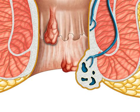 Not everyone, however, has hemorrhoid causing symptoms. Hemorrhoids Los Angeles | Gastroenterologist | Mark M ...