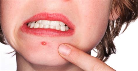 According to the dictionary, a pimple is an inflamed spot on your skin. HOW TO AVOID PIMPLES: 10 Effective Ways To Prevent Having ...