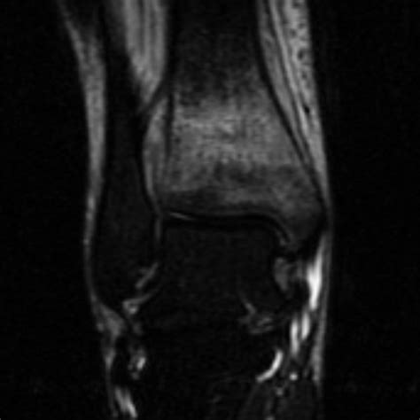 Fatigue fracture of the distal tibia | Image | Radiopaedia.org