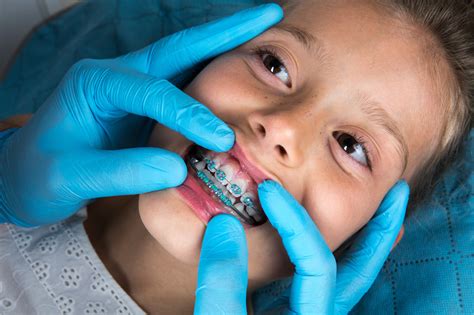 Rather than changing the position of the teeth, a dentist can place veneers on crooked teeth to make them look straighter. When Should Kids Get Braces? 5 Signs Your Child Is Ready ...