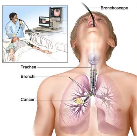 Temukan produk baru, penawaran & promosi dan hemat hingga 60% di iprice indonesia. N-Medical Solution: Bronchoscopy Bronkoskopi