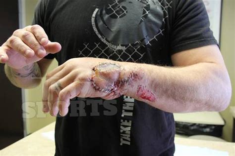 At best, you'll get a grazing shot, or hit in soft tissue. New, disgusting photos surface of Joe Riggs hand post ...