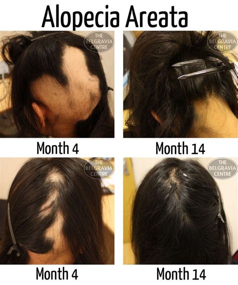 Advice and treatment for hair loss & scalp diseases. Pin on Alopecia hair growth