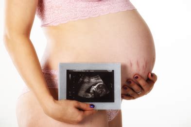 Durch die risse schimmern die darunter liegenden blutgefäße. Schwangerschaftsstreifen vermeiden - Wissen & Tipps ...