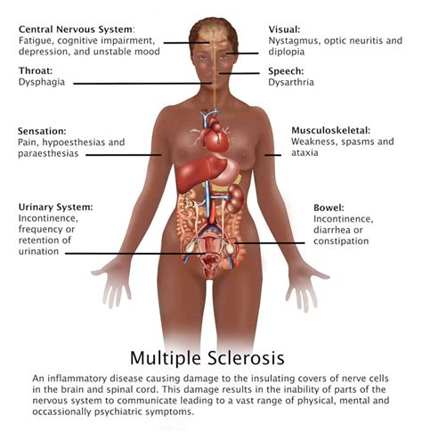 The disorder is characterized by destruction of the myelin. What to know about multiple sclerosis - Health News 2 me