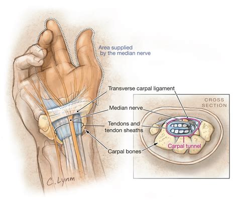 Carpal tunnel syndrome is a condition in which the median nerve, which runs from the hand to the forearm, becomes compressed. Carpal Tunnel Syndrome | Neurology | JAMA | JAMA Network