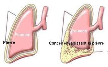 Le feuillet nommé plèvre viscérale ou plèvre pulmonaire couvre la face externe des. Le mésothéliome