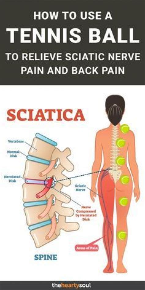 Sciatica, or pain of the sciatic nerve, is caused by a pinching of these nerves. Pin on Joint Pain relief
