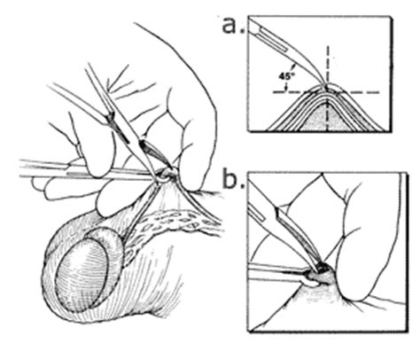 O tamanho médio da incisão é de 1 a 2 cm. LA VASECTOMIA: mayo 2013