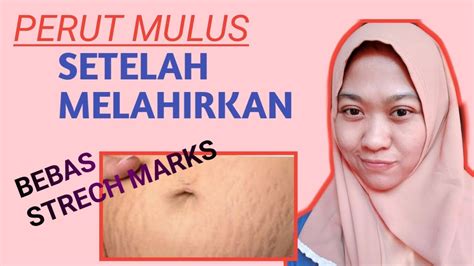 Stretch mark bisa juga disebabkan oleh kenaikan berat badan. CARA MENCEGAH STRECH MARKS SETELAH MELAHIRKAN - YouTube