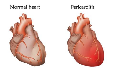 Ορισμένα άτομα με οξεία περικαρδίτιδα περιγράφουν τον πόνο στο στήθος πιο ήπιο, συνεχή που χειροτερεύει όμως με τη βαθιά εισπνοή και την κατάκλιση σε ύπτια θέση. Πόνος στο στήθος: Οι πιθανές αιτίες πλην της καρδιάς-ΦΩΤΟ