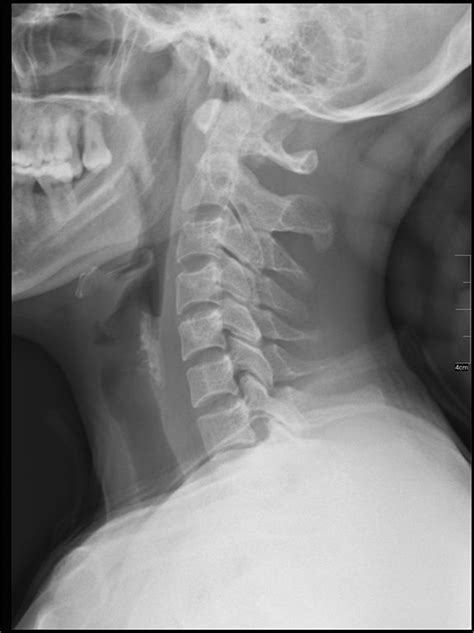 The high complexity of the anatomical structure of the craniovertebral zone explains the need to identify the main radiographic guidelines used in its evaluation. How This Chiropractor Treats Headaches - Favero ...