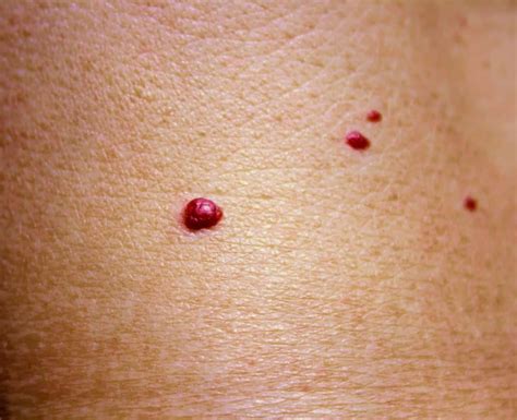 Cherry angioma is the most common type of angioma and is a common skin growth. Cherry Angioma Removal | Lipo Sculpt.co.uk