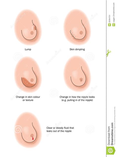 La recherche de l'écoulement se fait par pression du sein puis expression du mamelon. Signes De Cancer Du Sein Image stock - Image: 25364751