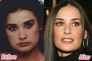 Just stop it, says laura craik. Demi Moore Plastic Surgery Before and After Breast ...