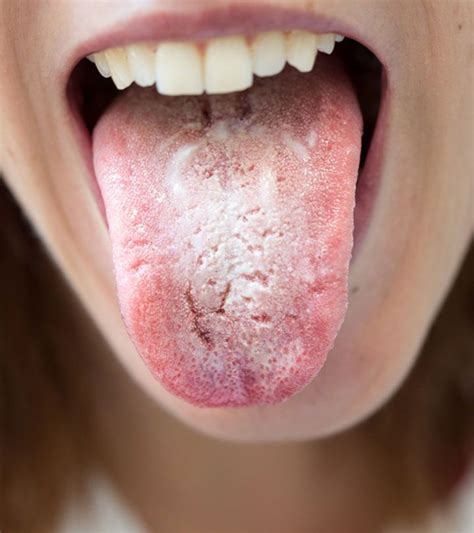 See full list on healthjunta.com 10 Ways To Get Rid Of White Tongue And Make It Healthier ...