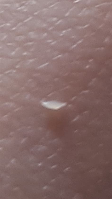 Sebum is produced on every inch of your skin except. Tiny white plugs - General acne discussion - Acne.org