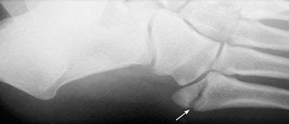 Metatarsal Fractures - Physiopedia | Jones fracture ...