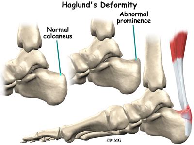 Surgical treatment for haglund's deformity. Haglund's Deformity | eOrthopod.com