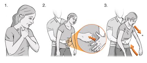 Heimlich manevrası, yabancı cisim tarafından solunum yolunun tıkanması ile oluşan boğulma durumlarında uygulanan ve hayat kurtaran bir manevradır. Çocuklarda yabancı cisim aspirasyonu | Dr.Bülent Aldemir