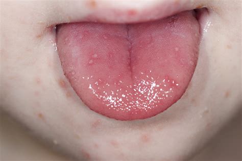 Don't hug or kiss someone who has hand, foot, and mouth disease. Hand-Foot-and-Mouth Disease (HFMD) - Infectious Diseases ...