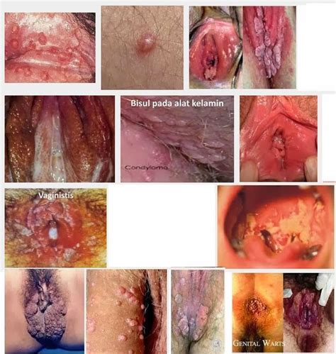 Contoh soal psikotes gambar + pembahasan  gambar orang pohon wartegg rumah . Contoh Gambar Penyakit Kelamin Pada Wanita