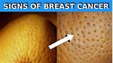 Breast cancer causes, symptoms & signs. 15 Warning Signs Of Breast Cancer You Shouldn't Ignore ...