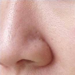 There are many causes of this skin condition and the most common are. How to Close Open Pores - Top 10 Remedies | The Organic ...