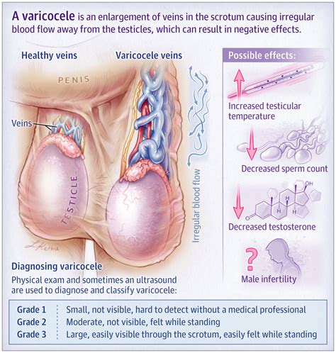 It's not clear what causes the testicle. JAMA Patient Page - Varicocele | Center for Male ...