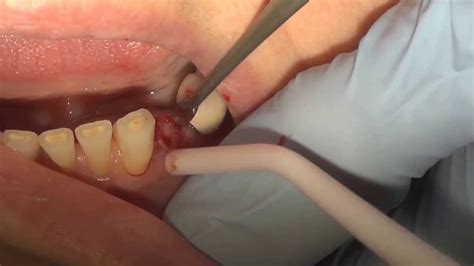 Chipped, cracked and broken teeth. How to pull a broken tooth - YouTube