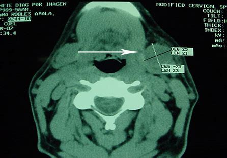 El adenoma pleomorfo metastásico se conoce desde la década de 1940. Patologías en Glándulas Salivales - www.maxilofacialcdmx.mx