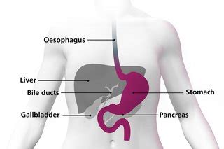 In countries where screening for stomach cancer is not routine, such as the united states, most stomach cancers aren't found until they've grown fairly large or have spread outside the stomach. Symptoms of stomach cancer - NHS