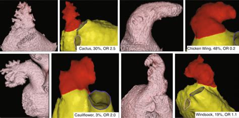 And in the first video of this series will look into. Use of Mechanical Devices to Reduce Stroke in Atrial ...