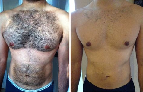 Leave it on for about 20 minutes, and repeat three times a week for up to three months. What is the solution for me to remove my body hair ...