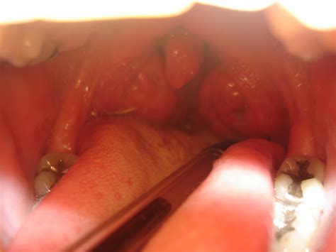 Sore throat can be contagious. Home Test For Strep Throat May Save Costly Doctor's Visits