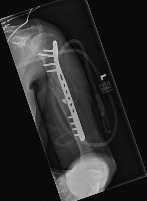 A spiral fracture of the humerus shaft. Shoulder and Elbow Surgery: Failure of healing (nonunion) of spiral diaphyseal closed humerus ...