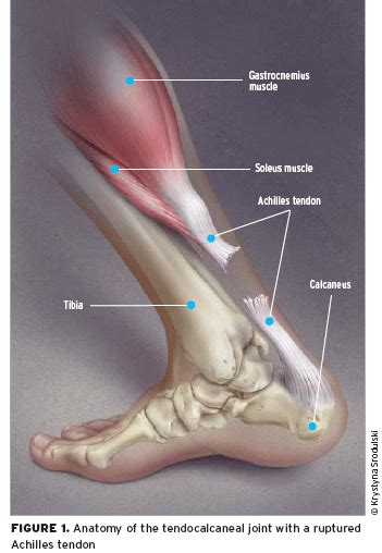 Diagram showing earthquakes and movement of the crust. Achilles Tendon Rupture - Achilles Tendinitis- Kin 480