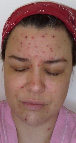 Tidak susah nak hilangkan parut demam campak chicken pox ini. Cara Hilangkan Parut Chicken Pox Agar Muka Cantik Berseri ...