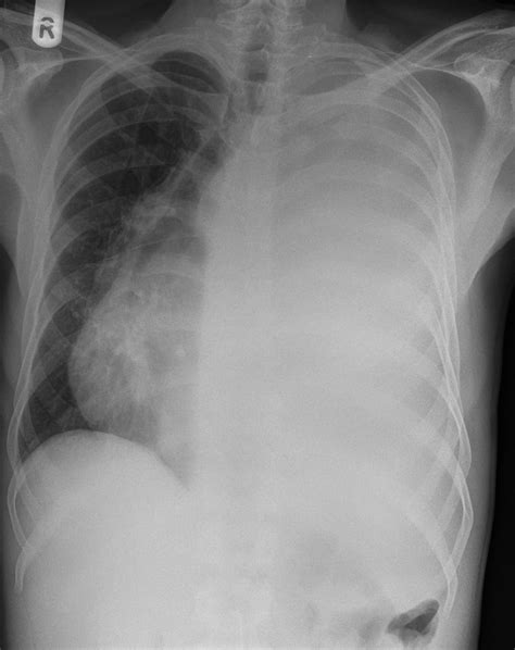 As the subpulmonic effusion grows in size, it first fills and thus blunts the posterior costophrenic sulcus, visible on the lateral chest. Pleural effusion: massive with shift | Radiology Case ...