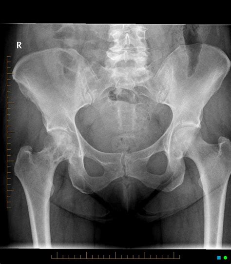 Or a dramatic, sudden fracture. Dermal papillomatosis - Cancer familial aggregation