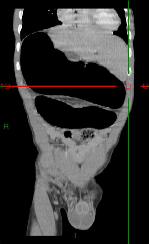 Computed tomography of the aorta from the chest to the pelvis in coronal plane cine mode abdominal aortogram ct. Abdominal-pelvic CT-coronal plane: colonic volvulus ...